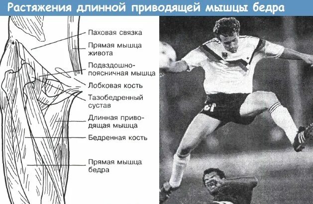 Растяжение в паху симптомы лечение. Надрыв приводящей мышцы. травма приводящей мышцы. растяжение приводящей мышцы.