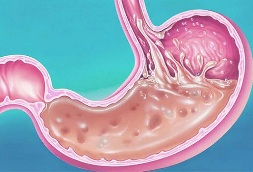 Полипы фундальных желёз желудка. Желудок содержимое слизь