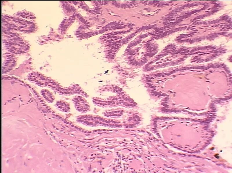 Папиллярная карцинома щитовидной железы гистология. Папиллярная аденокарцинома щитовидной. Папиллярная аденома щитовидной железы гистология. Цистаденома поджелудочной железы гистология. Папиллярный рак после операции