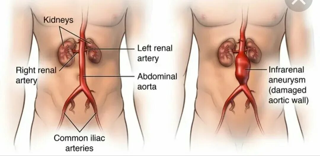 Брюшная ишемия. Аневризма брюшной аорты пульсация. 171.4 Аневризма брюшной аорты. Аневризма брюшной аорты расположение. Аневризма брюшной отдел аорты отделы.