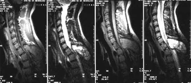 Опухоль спинного мозга мрт. Опухоль спинного мозга мрт снимок. Саркома позвоночника на мрт. Опухоль спинного мозга кт. Опухоль в поясничном отделе