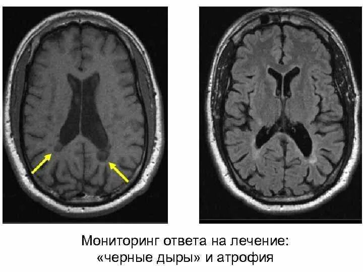 Очаги демиелинизации головного мозга на мрт. Черные дыры на мрт. Демиелинизирующий процесс мрт. Мрт при демиелинизирующем заболевании. Демиелинизация головного