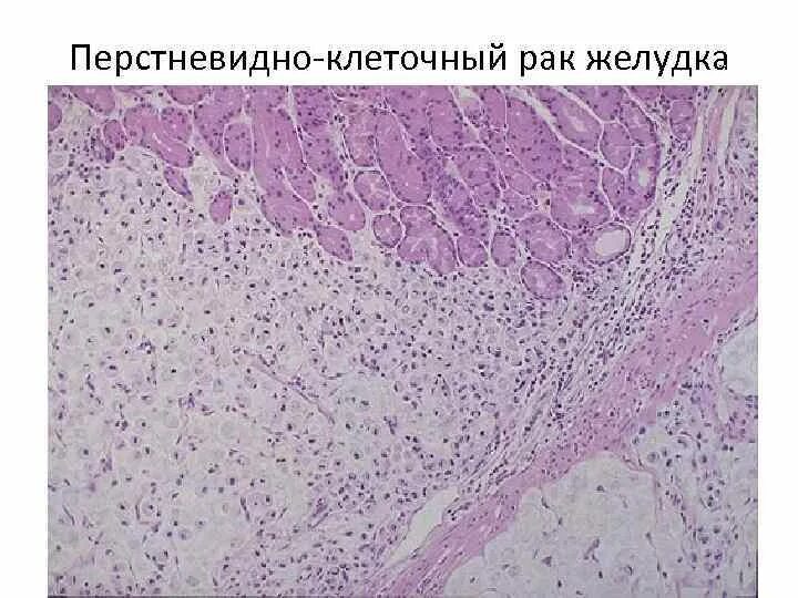 Гистология аденокарциномы. Злокачественный карциноид патанатомия. карциноид кишечника гистология. перстневидноклеточная аденокарцинома желудка g3. перстневидно-клеточный гистология.