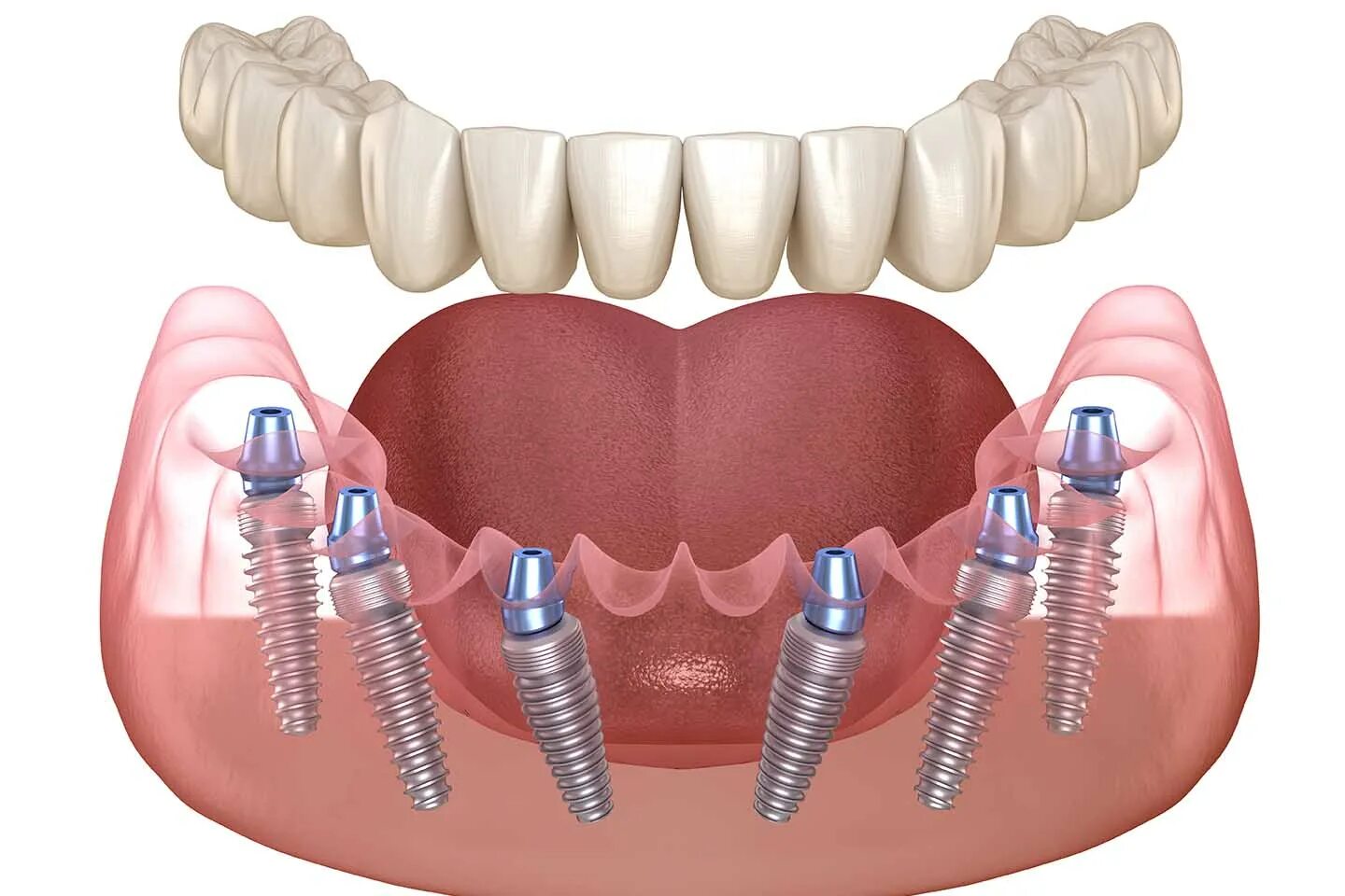 Несъёмный зубной протез на 6 имплантах. Имплантация челюсти на 6 имплантах. Имплантация зубов all on 6. Имплантация all-on-6 (имплантация на 6 имплантах).