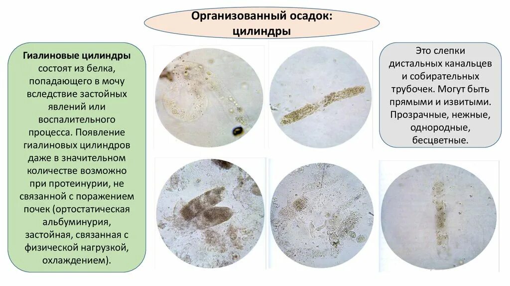 Моча цилиндры гиалиновые повышенные. Гиалиновый цилиндр в моче микроскопия. Гиалиновые и зернистые цилиндры. Микроскопическое исследование осадка мочи микроскоп. При микроскопии осадка мочи гиалиновые цилиндры выглядят в виде:.