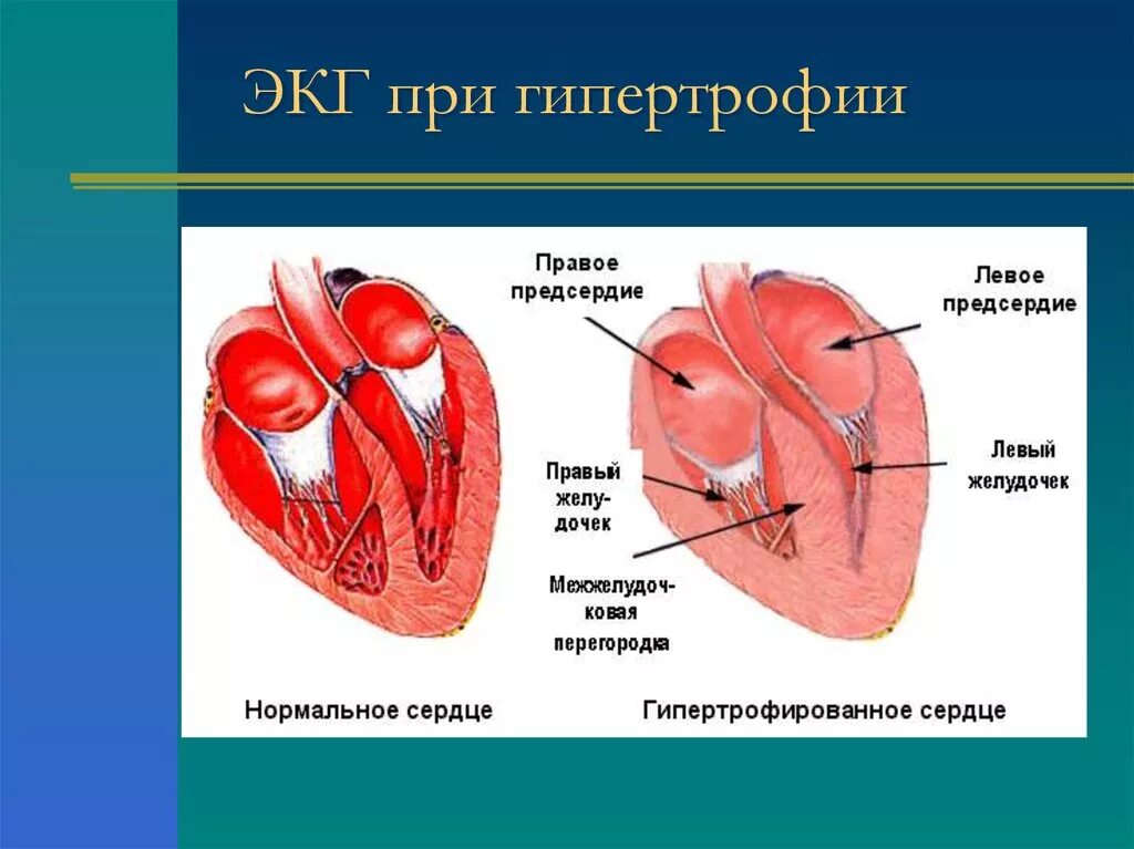 Гипертрофия предсердий. Гипертрофия миокарда предсердий. Гипертрофия отделов сердца. Левое предсердие увеличено