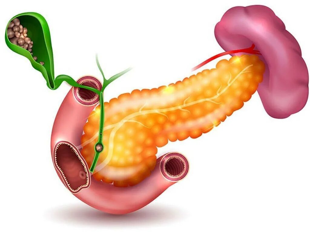 Острый панкреатит поджелудочной железы. Острый холецистит и панкреатит. Воспаление поджелудочной это панкреатит. Панкреонекроз поджелудочной панкреатит. Хронический холецистит гастрит