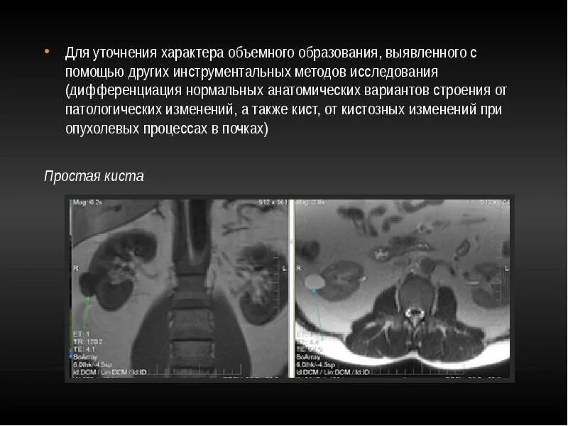 Объемные кистозные образования