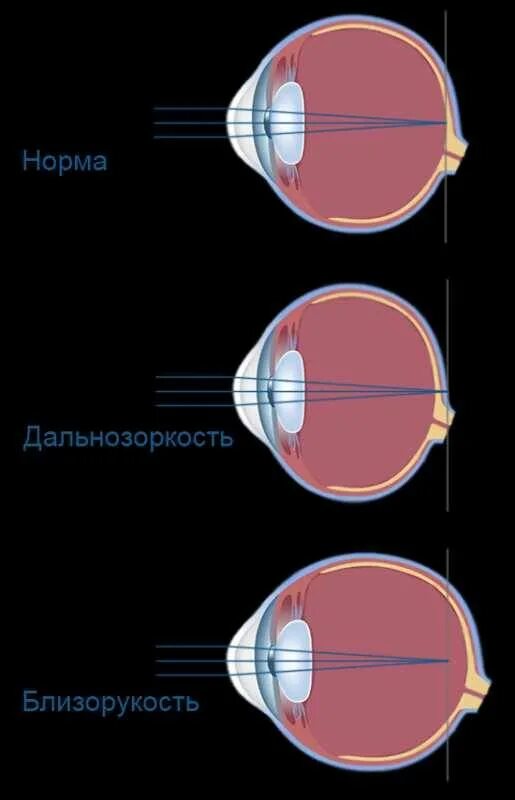 Миопия астигматизм глаз