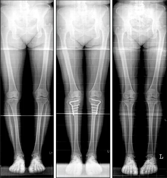 Варусная деформация нижних конечностей рентген. Вальгусная деформация коленных суставов рентген. Варусная деформация оси нижних конечностей. Варусная деформация коленных суставов.