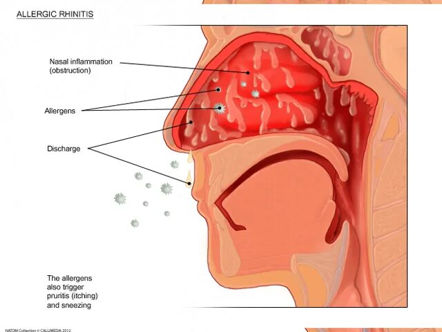 Заложенность носа температура 39. Слизистая оболочка при аллергическом рините. Аллергический насморк. Аллергический ринит в носу. Аллергический ринит слизистая носа.