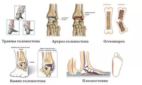 Артроз голеностопного сустава код мкб