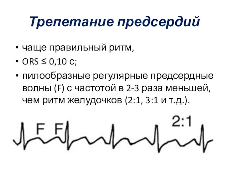 Трепетание предсердий 2 к 1 на ЭКГ. Трепетание предсердий 3:1. Трепетание предсердий волны f. Трепетание предсердий 4 к 1. Формы трепетания предсердий