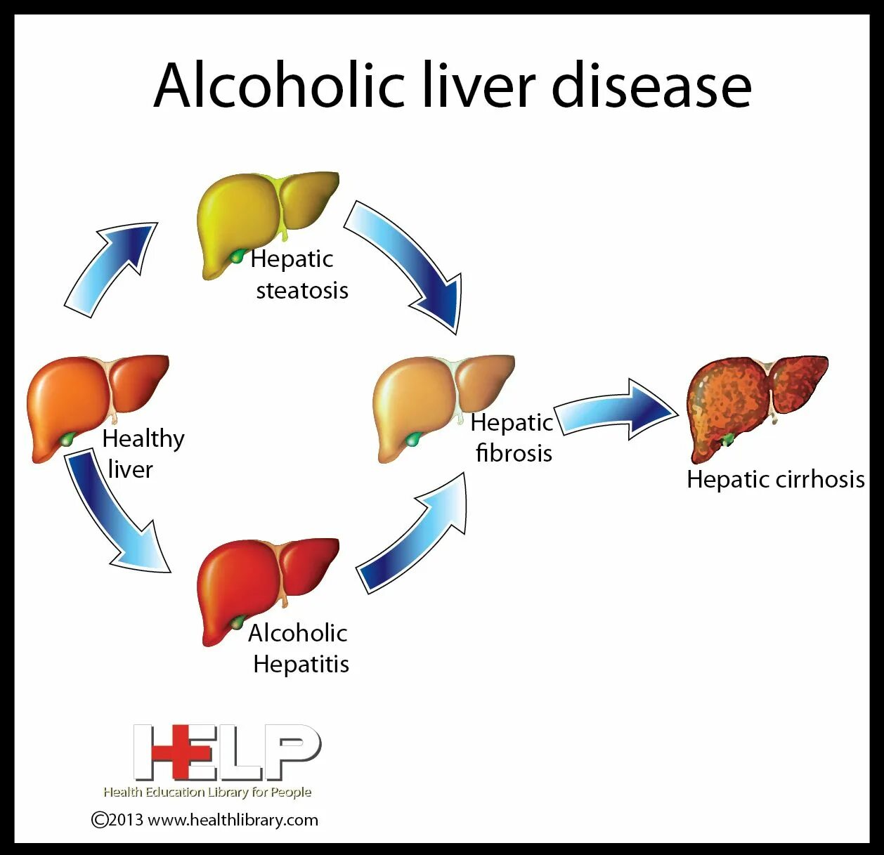 Генетический алкоголизм. Alcoholic disease. Fatty alcohols. Alcoholic disease. Alcoholic disease.