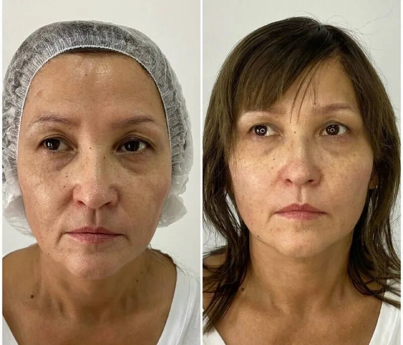 перманентный макияж скул. биоармирование лица гиалуроновой кислотой техника. рестилайн и скульптра косметология. поплыл овал лица. армирование лица гиалуроновой.