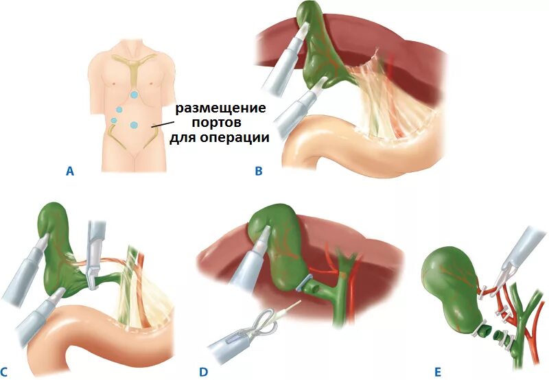 Острый холецистит хирургические. Холецистит и лапароскопическая холецистэктомия. Холецистэктомия желчного пузыря лапароскопическая. ЖКБ лапароскопическая холецистэктомия. Лапаротомия холецистэктомия.