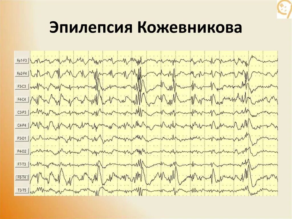 Эпи ээг. Джексоновская эпилепсия на ЭЭГ. Кожевниковская эпилепсия ЭЭГ. Эпилепсия Кожевникова. Эпилепсия ЭКГ.