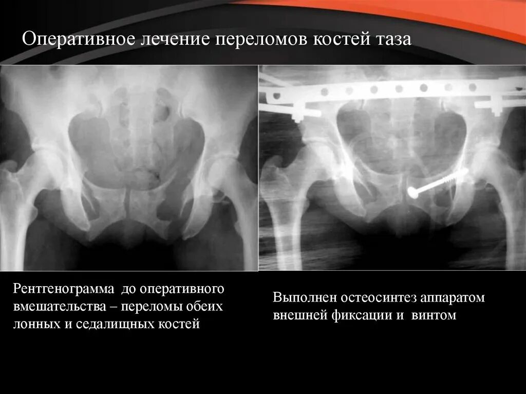 Оперативное лечение перелома костей. Перелом лонной и седалищной костей таза. Перелом лобковой и седалищной костей таза. Перелом лонных костей таза. Перелом костей таза рентгенограмма.