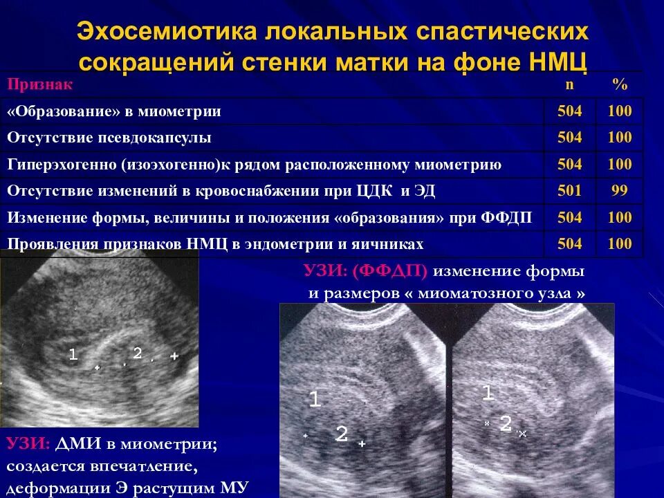 Гиперэхогенные диффузные. Локальный гипертонус миометрия. Локальный тонус миометрия по задней стенке.