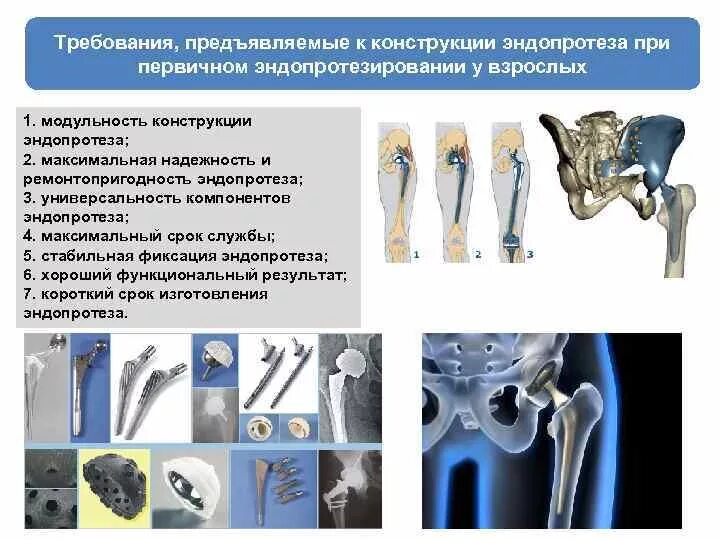 Виды эндопротезирования. Компоненты эндопротеза. Эндопротезирование тазобедренного сустава срок службы.