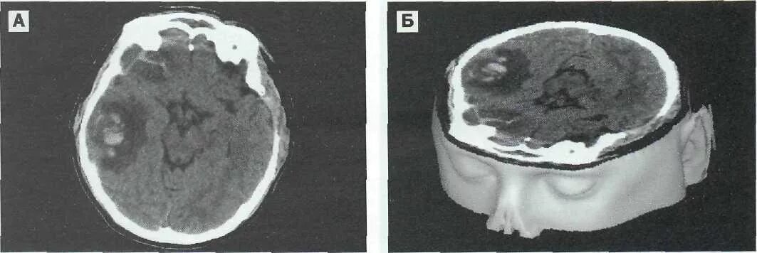 Черепно-мозговая травма кт. Черепно мозговая травма кт и мрт. Гематома черепно мозговой травме