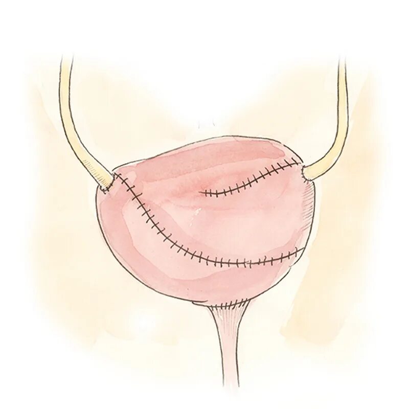 Расслабленный мочевой пузырь. Мочевой пузырь. Операции на мочевом пузыре. Ампутация мочевого пузыря.