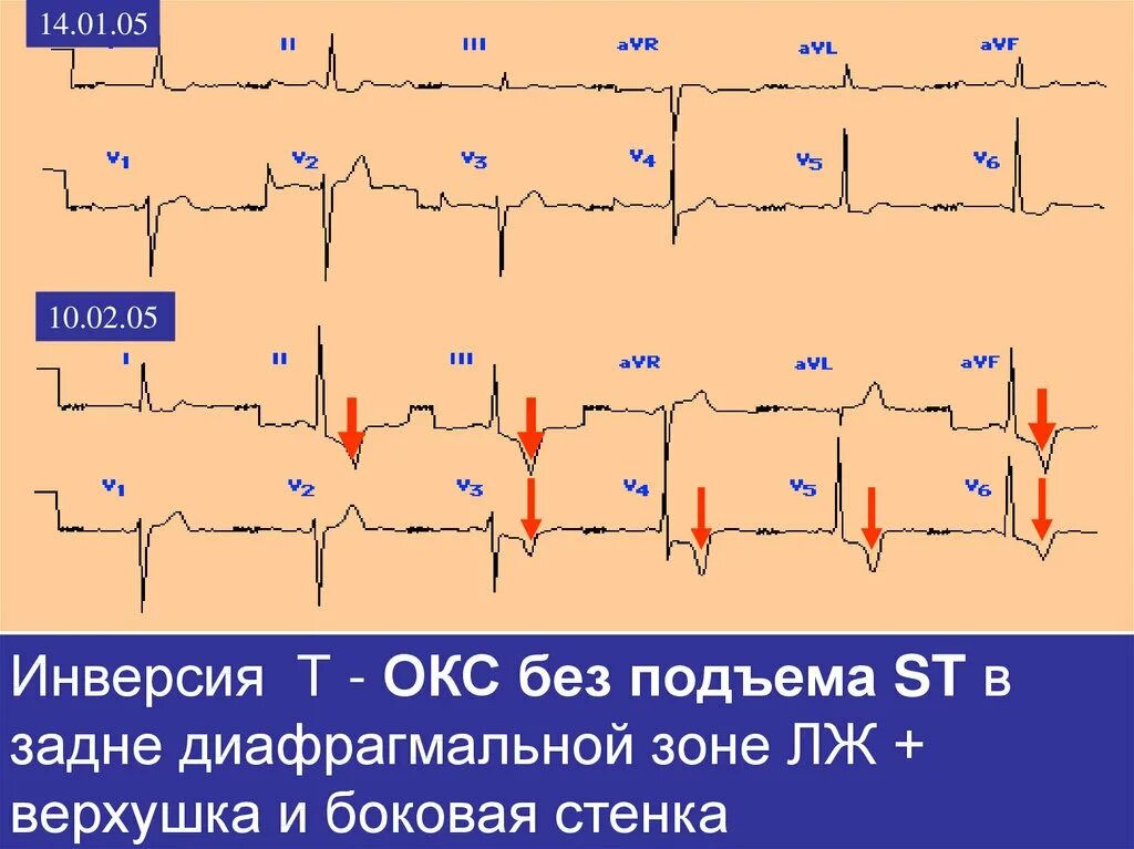 Острый коронарный синдром инфаркт. ЭКГ при инфаркте миокарда без подъема St. Окс без подъема St на ЭКГ. Инфаркт миокарда с подъемом сегмента ст ЭКГ. Инфаркт миокарда без подъема сегмента ЭКГ.