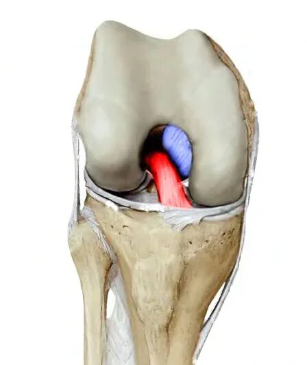 Крестовидная коленная связка. Разрыв мениска и крестообразной связки. Разрыв крестообразной связки коленного сустава.