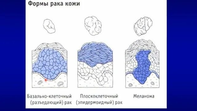 Базальная опухоль