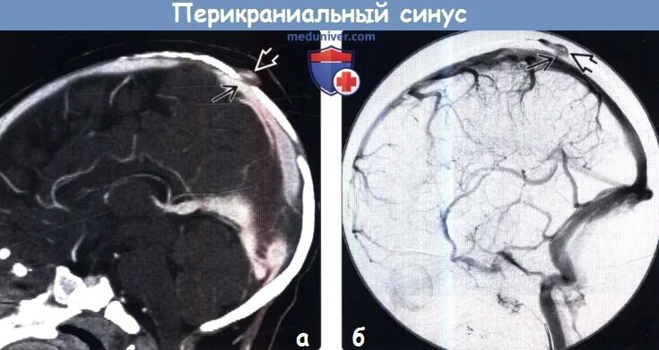 Перикраниальный синус. Киста поперечного синуса. Гипоплазия поперечного синуса слева. Синус перикраниальный МСКТ. Гипоплазия правого поперечного синуса