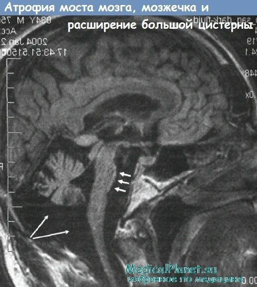 Атрофия ствола мозга на мрт. Церебеллярная дегенерация. Мозжечковая атаксия мрт. Спиноцеребеллярная дегенерация. Диффузная атрофия головного мозга