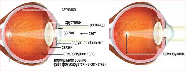 После замена хрусталика туман в глазу