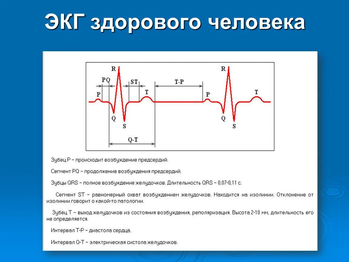 Схема ЭКГ здорового человека. ЭКГ заболевания сердца с расшифровкой. Рисунок расшифровка электрокардиограммы. Как выглядит ЭКГ здорового человека. Тяжелое экг