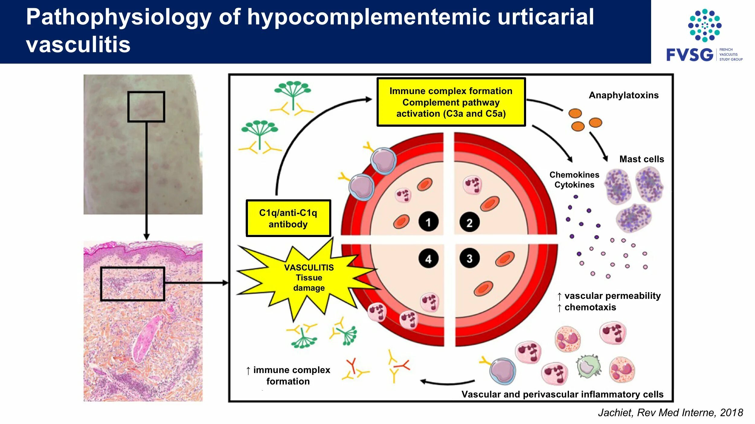 Васкулит патогенез. Systemic Vasculitis.