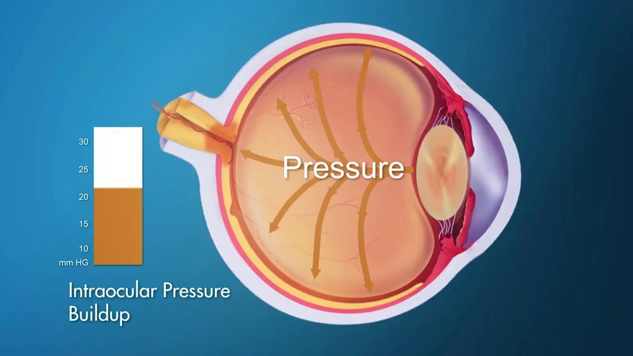 Внутриглазное давление. Увеличение внутриглазного давления. Повышенное ВГД. Внутриглазное давление повышено.
