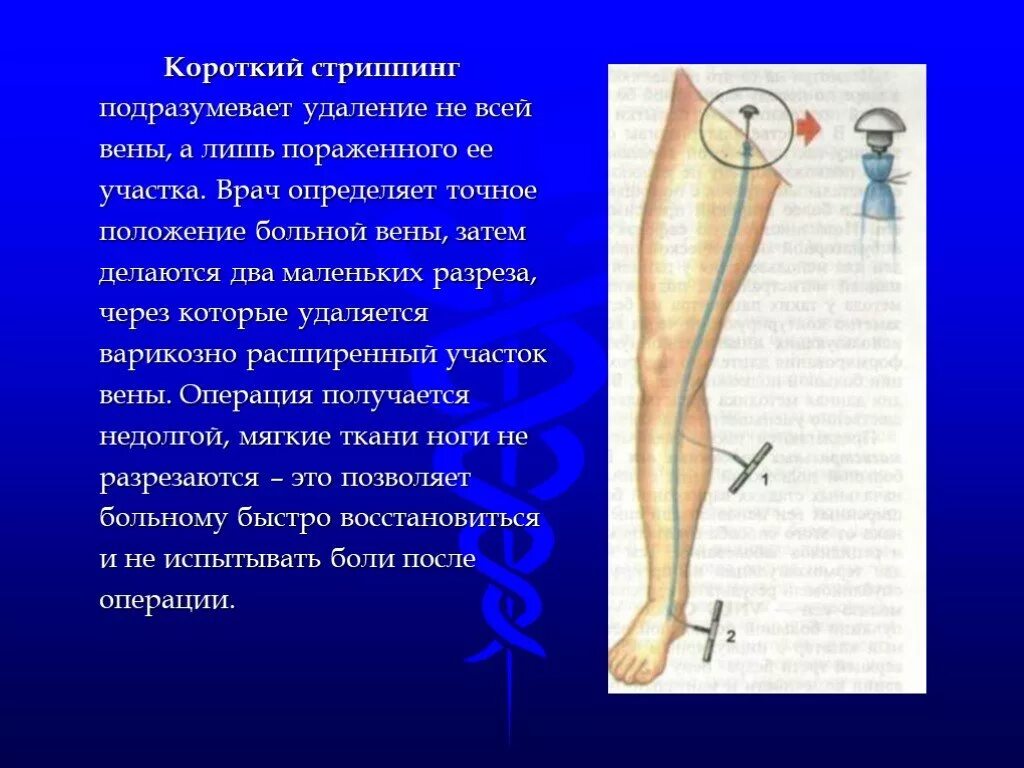 Стриппинг большой подкожной вены. Стриппинг варикозных вен. Короткий стриппинг большой подкожной.