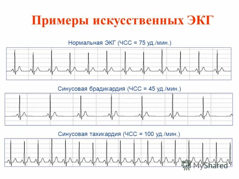 амортизация срок полезного использования норма амортизации. экг ритм синусовый чсс 676. синусовый ритм с чсс 120-90уд/мин, нормальная эос. кардиограмма сердца синусовый ритм норма. синусовая аритмия с чсс.