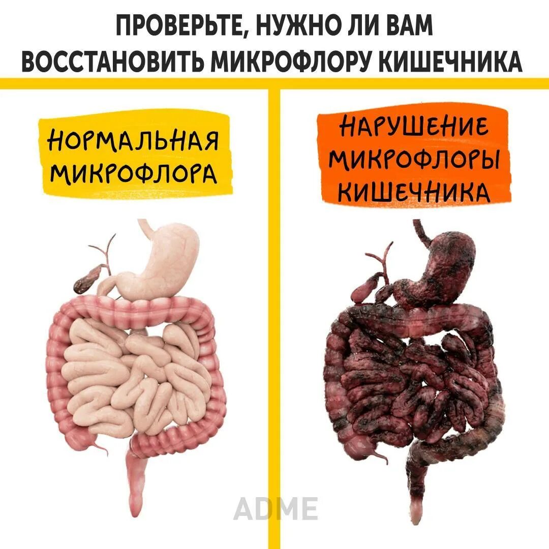 кишечник бактерии микробиом. бактерии бифидобактерии для кишечника. микрофлора кишечника. основные проявления дисбиоза кишечника. полезные бактерии в микрофлоре кишечника.