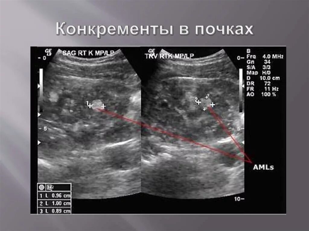 Камень в мочеточнике на узи. Узи картина камней в почках. Камни в почках снимки узи. Гиперэхогенная структура на узи. Конкременты в почках на узи что это такое.