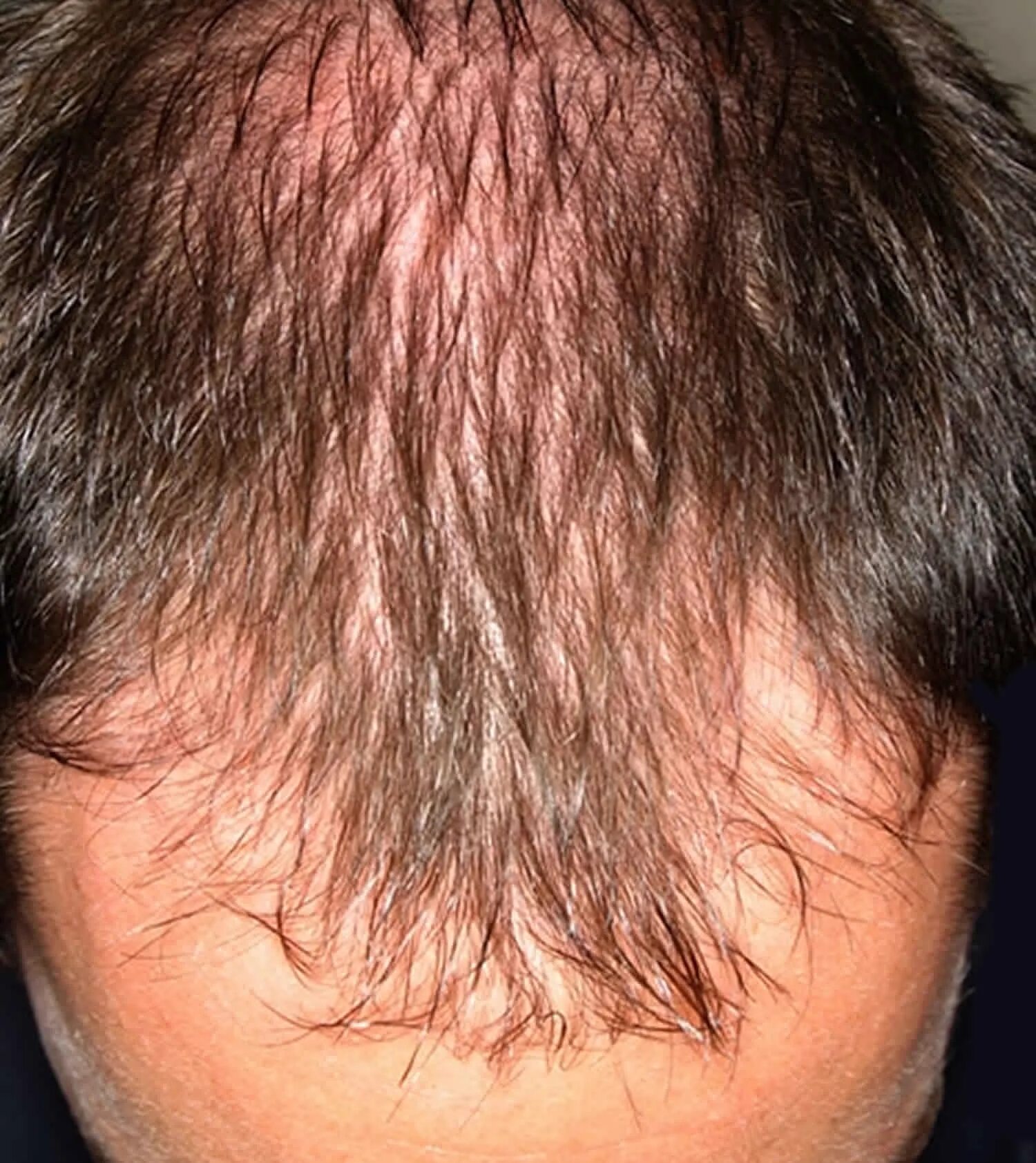 Андрогенная алопеция миноксидил. Очаговая алопеция (alopecia Areata). Выпали волосы на висках