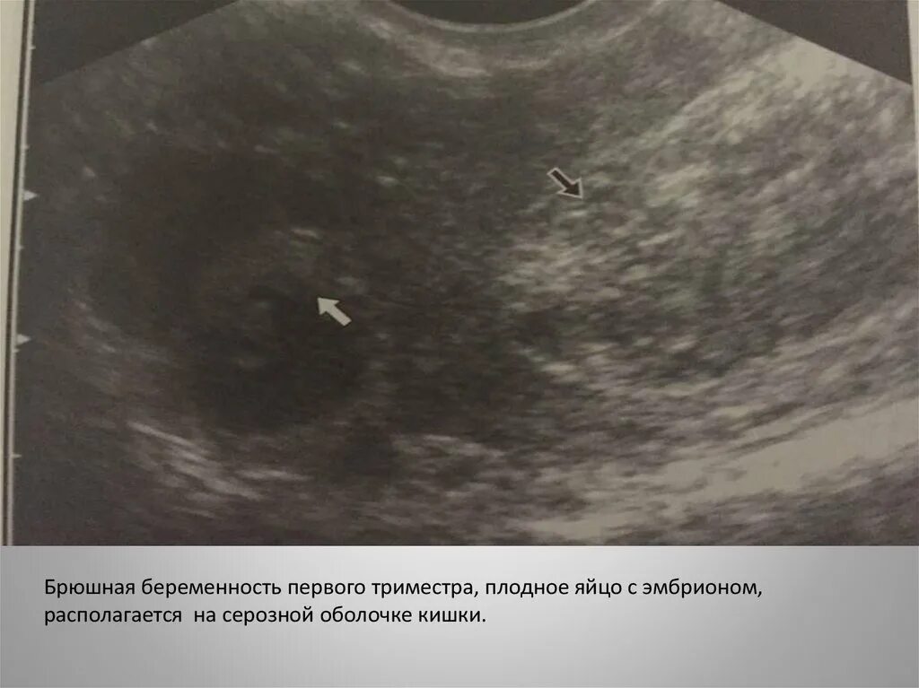 Трансвагинальное узи на ранних сроках беременности. Брюшная внематочная беременность на УЗИ. Плодное яйцо в брюшной полости. Брюшная внематочная беременность. Брюшная внематочная беременность симптомы.