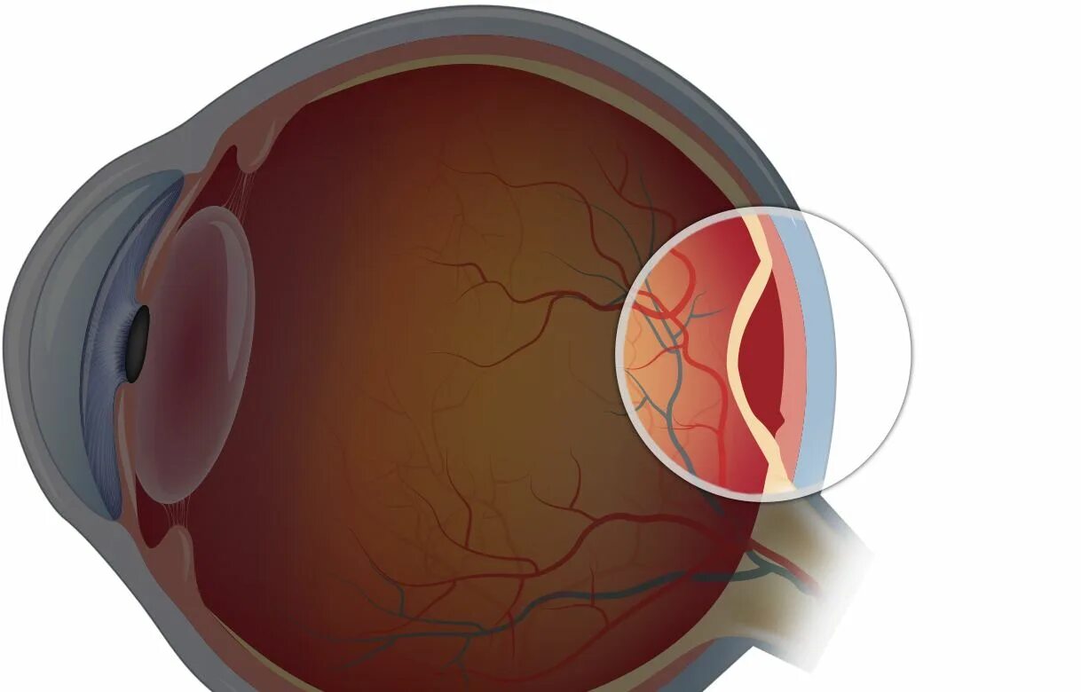 Разрыв сетчатки (retinal tear). Тотальная отслойка сетчатки. Высокая отслойка сетчатки. Повреждение сетчатки