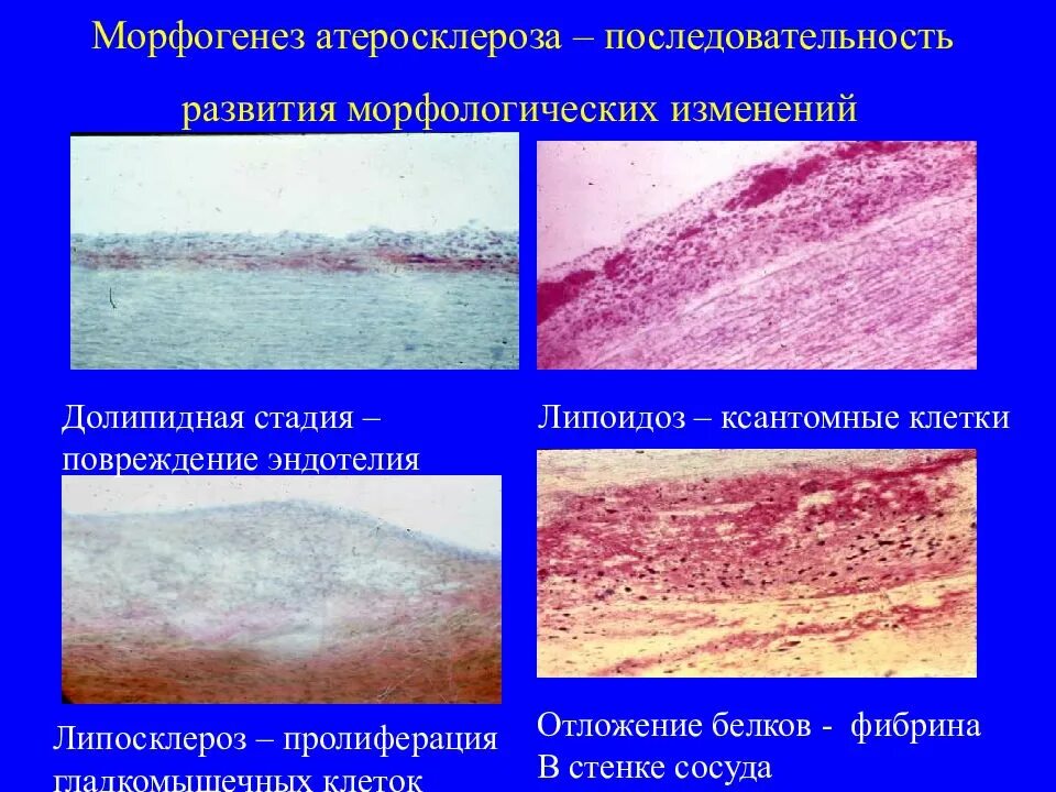 Морфологические изменения организма это. Степени атеросклероза патанатомия. Макроскопические стадии атеросклероза. Долипидная стадия атеросклероза патанатомия. Микроскопические стадии атеросклероза.