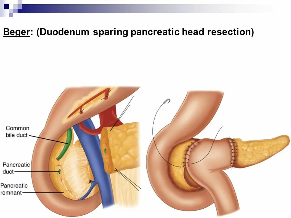 Операция Бегера на поджелудочной железе. Операция Фрея на поджелудочной. Бернский вариант резекции головки пж.