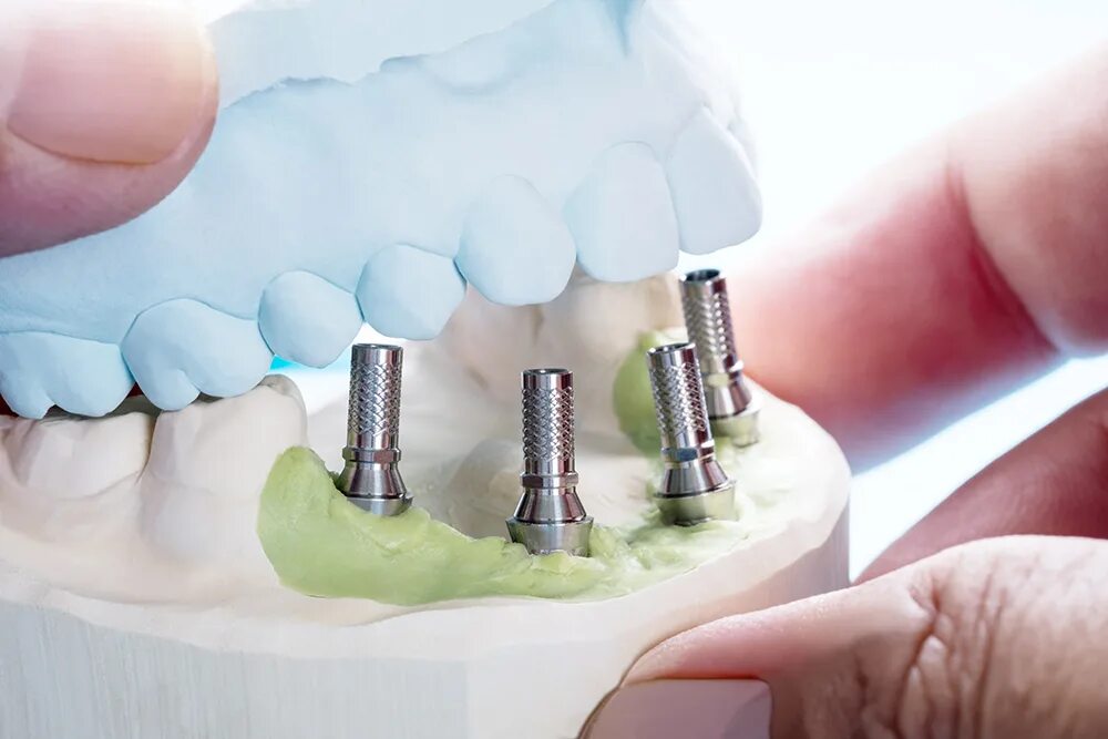 On 1 Abutment Implant. Зубные протезы на имплантах. Как называется протезист