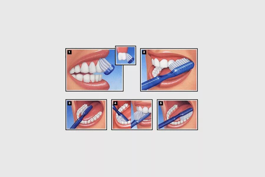 Метод чистки зубов метод Леонарда. Стандартный метод чистки зубов Пахомова г. н.. Стандартная чистка зубов щеткой. Круговой метод чистки зубов fones.