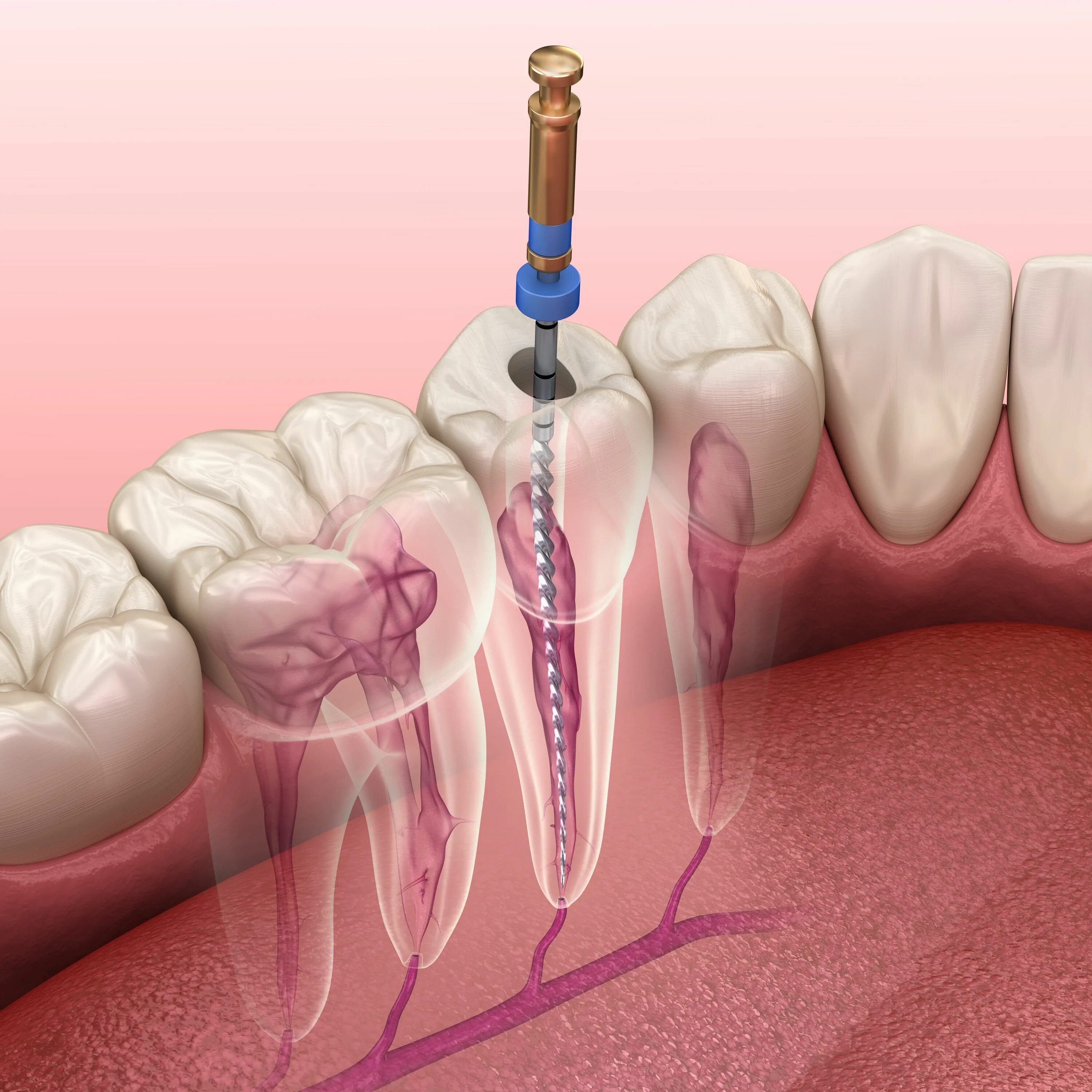 Root canal