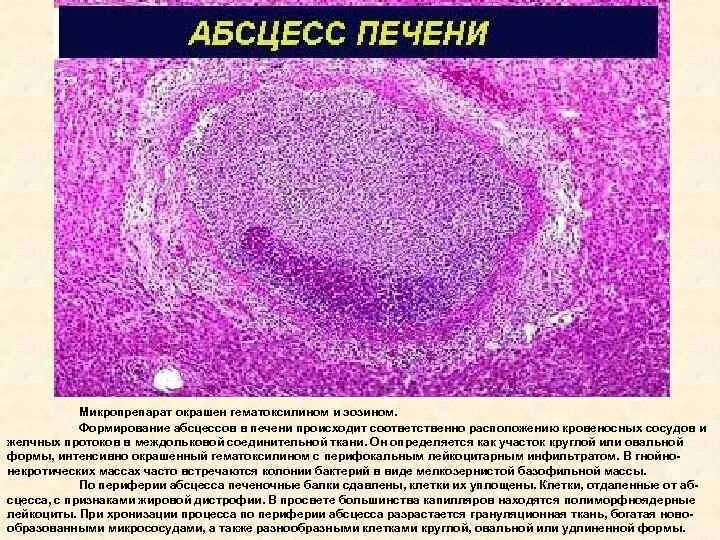 Печень микропрепарат описание. Абсцесс печени микропрепарат. Хронический абсцесс гистология. Абсцесс печени Макропрепараты. Абсцесс печени микропрепарат описание.