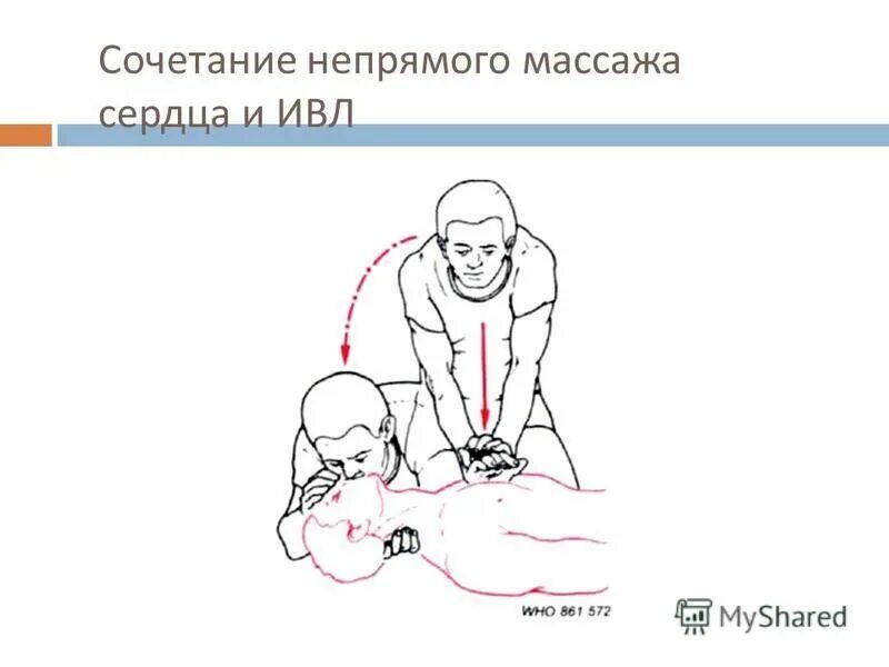 Непрямой массаж сердца и искусственную вентиляцию. Сочетание непрямого массажа сердца и ивл. сочетание непрямого массажа и ивл. ивл и непрямой массаж сердца алгоритм.
