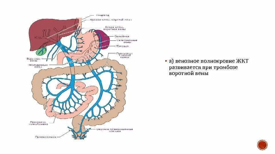 Тромбоз воротная Вена печени. Синдром воротная Вена. Воротная Вена схема. Тромб в печени